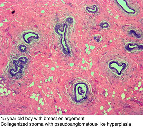 Pathology Outlines Gynecomastia