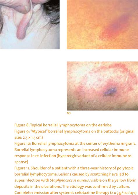 Figure 6 From Cutaneous Manifestations Of Lyme Borreliosis Semantic