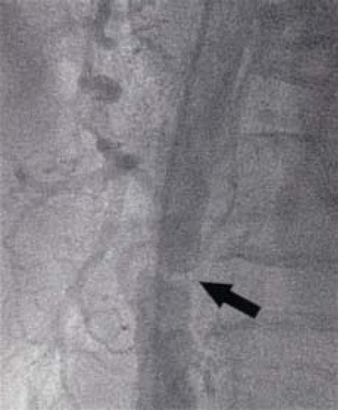 The Aortography Shows A Localized Abdominal Aortic Stenosis At The Download Scientific Diagram