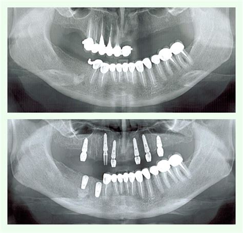 Implantul Dentar Ghidat Digital In Clinica Naturalsmile