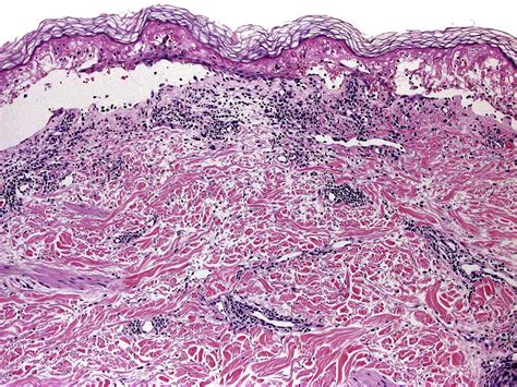 Severe Cutaneous Adverse Drug Reactions Diagnostic Histopathology