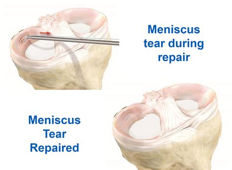 Arthroscopic Meniscus Surgery Dr Reetadyuti Mukhopadhyay