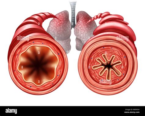 Asthma Diagram As A Healthy And Unhealthy Bronchial Tube With A