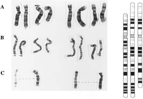 Figure 1 From The Spreading Of X Inactivation Into Autosomal Material