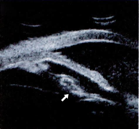 Ultrasound Biomicroscopy Of The Right Eye With Thickening Of The