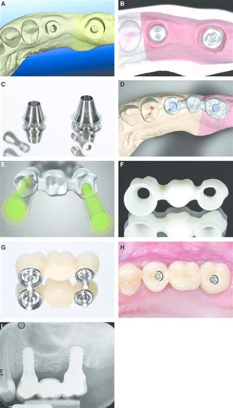 Mixed Conventionaldigital Workflow For Treatment With A Threeunit