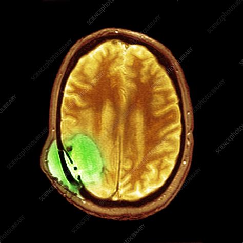 Brain Cancer After Surgery MRI Scan Stock Image F012 1383