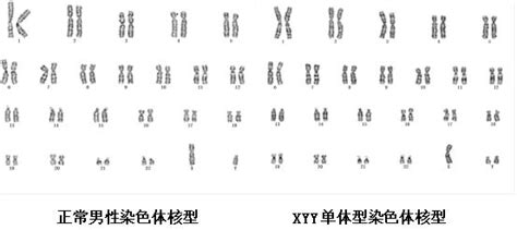 “第三性别”男子染色体多了一条y，将过怎样的人生？