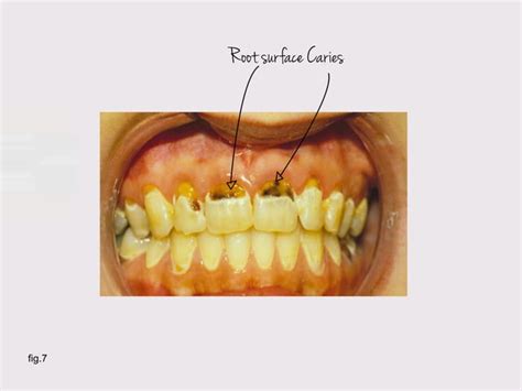 Microbiology Of Dental Caries Ppt