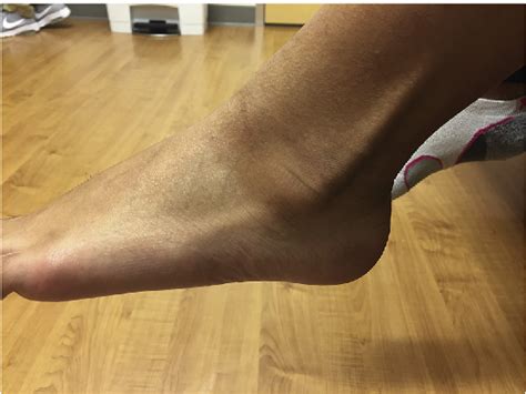 Figure 2 From Posterior Ankle Impingement Disguised As Peroneal Tendon