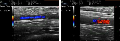 Temporal Artery Ultrasound