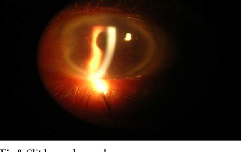 Figure 1 From Descemet S Membrane Detachment Repair With Sodium Hyaluronate After