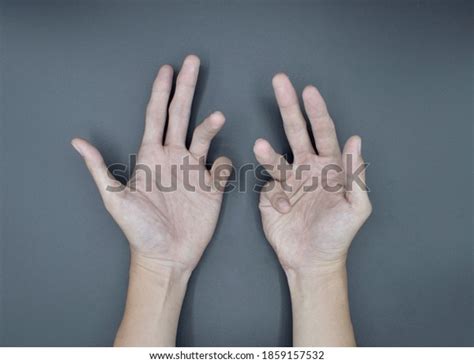 Ulnar Nerve Palsy: Over 25 Royalty-Free Licensable Stock Photos ...