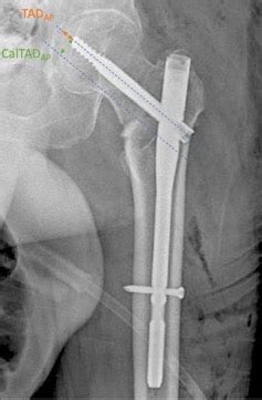 Cephalomedullary Nailing For Reverse Oblique Intertrochanteric