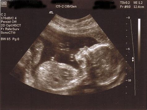 3d ultrasound pictures of twins | itcesasquez