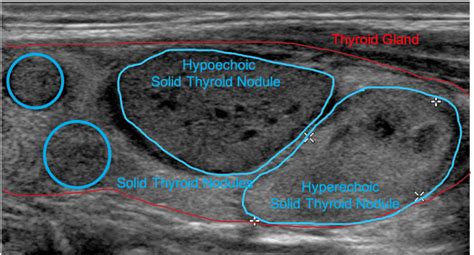 Normal Vs Abnormal Thyroid On Ultrasound Rfa For Life