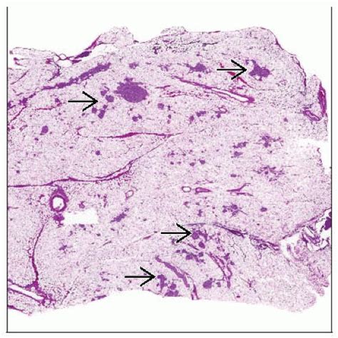 Cystic Fibrosis, Pancreas | Basicmedical Key