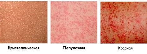 Потница у детей и взрослых: симптомы, как быстро вылечить | Legkomed.ru