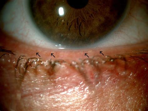 Meibomian Gland Dysfunction And Treatment American Association For Pediatric Ophthalmology And