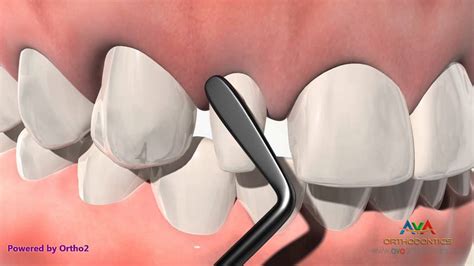 Orthodontic And Restorative Treatment For Small Or Peg Lateral Incisor