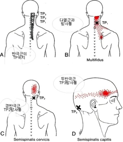 두통 오른쪽 뒷머리통증 네이버 블로그