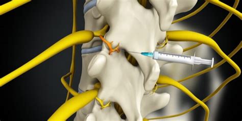 Medial Branch Nerve Block : Procedure, Types and Side Effects – Thomas ...