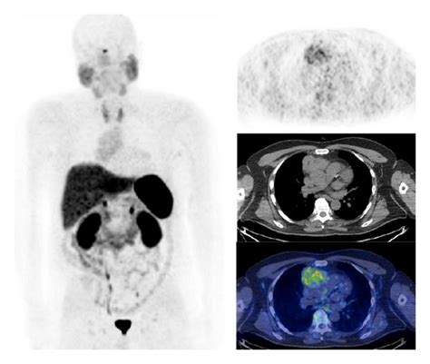 Ga Dotatate Pet Ct Images Mip Axial In A Patient With Thymoma