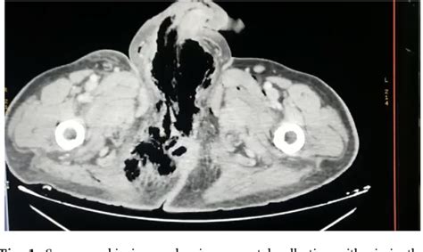 Figure From Fournier S Gangrene Revealing An Aggressive Squamous Cell