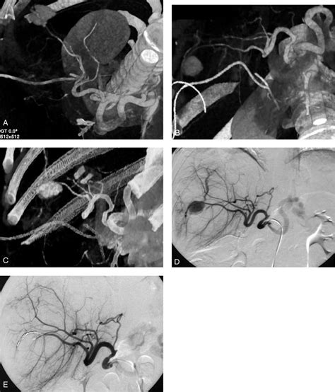 A E A Year Old Man With Incidental Hepatic Artery Pseudoaneurysm