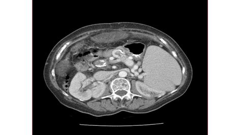 Portal vein thrombosis CT - wikidoc