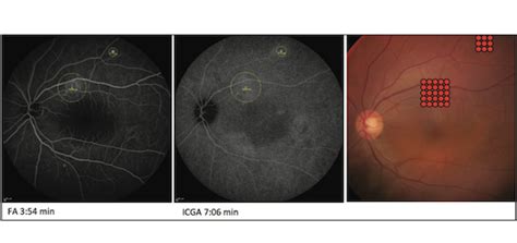 Micro Pulse Yellow Laser For The Treatment Of Central Serous