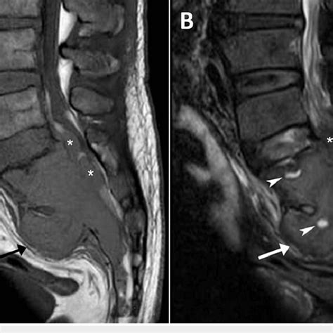 Lumbar Spine Magnetic Resonance Imaging T1 Weighted A And