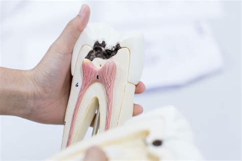 Cavity Symptoms: How to Identify Signs Of Cavity