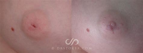 Nipple Inversion Correction Before And After Pictures Case Los