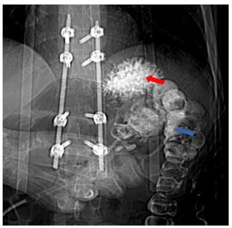 A Rare Case of Severe Diarrhea: Gastrocolic Fistula Caused by Migration