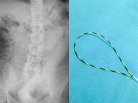 Mi Fa Male La Pancia Ma Si Era Infilato Un Dildo Di 60 Cm Salvato Dai Medici A Milano Il