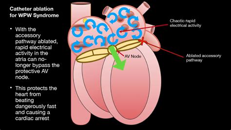 Atrio Ventricular Reentrant Tachycardia Avrt And Wolff Parkinson
