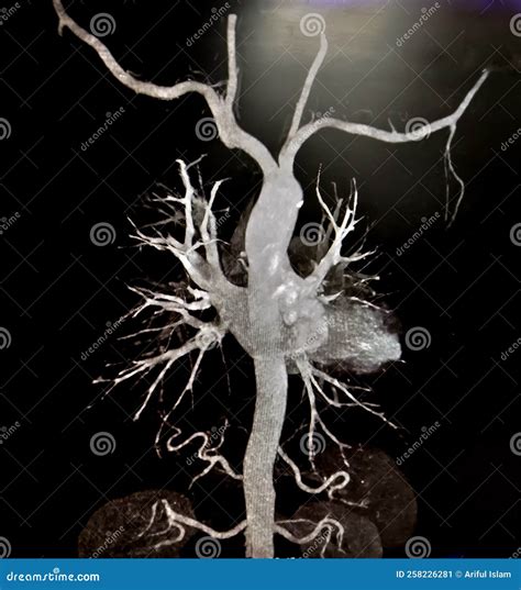 CT Angiography (Computed Tomography Angiography). Stock Image - Image