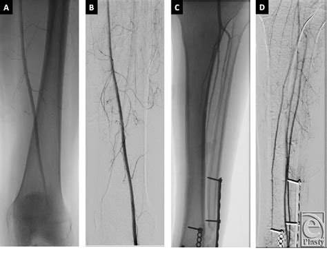 Figure From The Chimeric Myo Osseous Medial Femoral Condyle Flap For