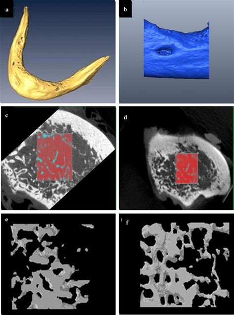 Comparison Of Trabecular Bone Microstructures Of Human Edentulous