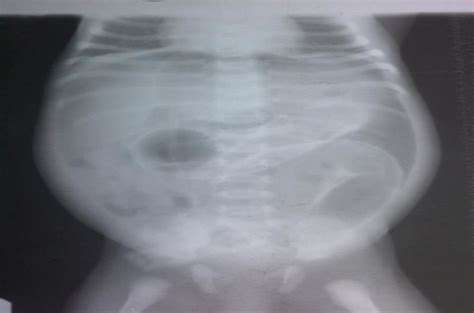 Supine Abdominal Radiograph Showing Rigler S Sign Curved Arrow And Download Scientific