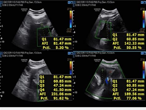 Usg Image Showing Afi At 34 Weeks Of Gestation For The First Patient