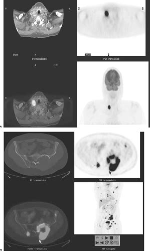 Thyroid Radionuclide Uptake And Imaging Studies Oncohema Key