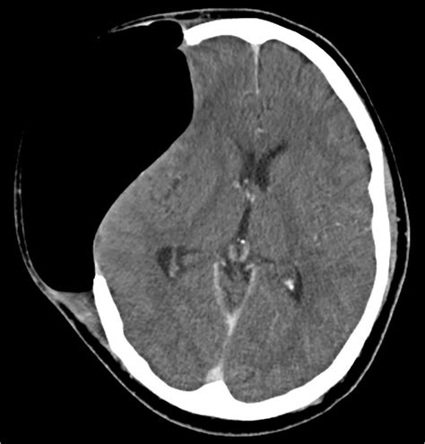 Delayed Tension Pneumocephalus Following Decompressive Craniectomy