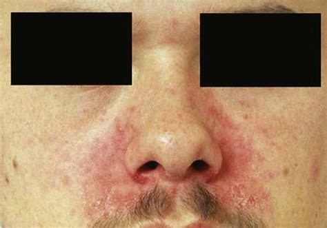 Cleveland Clinic Dermatologic Signs Of Systemic Disease Virtual