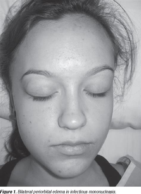 Figure 1 From Association Of Periorbital Edema And Fever In Acute