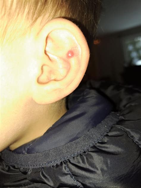 4yo With Red Bump on Ear : r/DermatologyQuestions