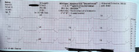 79 Yom Substernal Chest Pain Ekgs