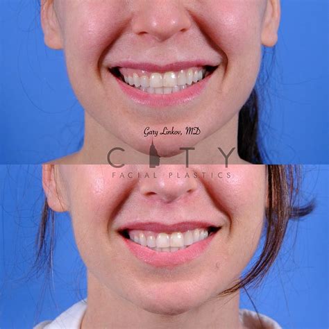 Lip Lift Before And After New York Plastic Surgeon Dr Linkov