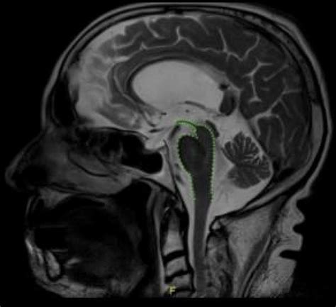 Hummingbird Sign Mri